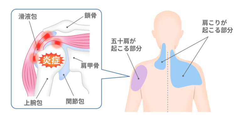 肩関節周囲炎(四十肩・五十肩)