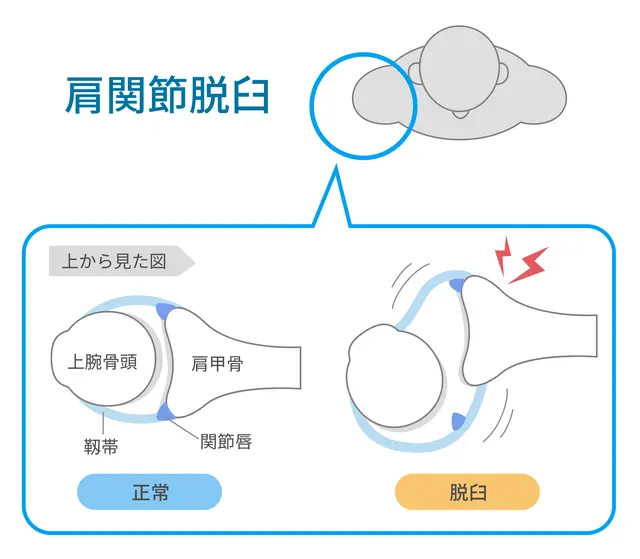 肩関節脱臼の原因