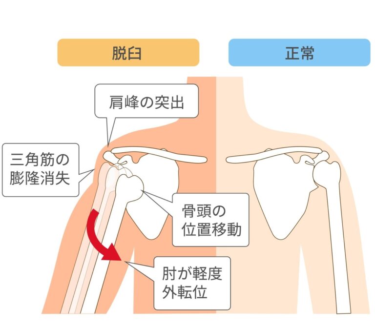 肩関節脱臼のメカニズム