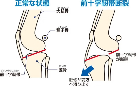 前十字靭帯断裂のメカニズム