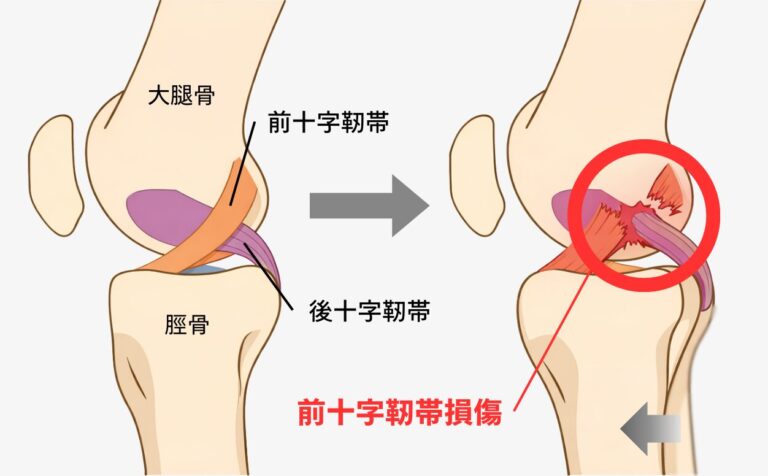 前十字靭帯再建術について